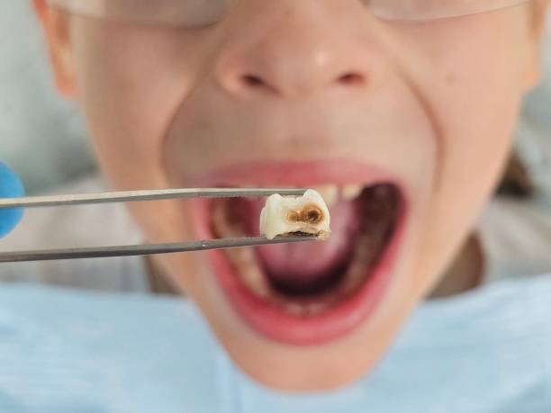 Best Emergency Treatment for Toothache in Ranger, TX